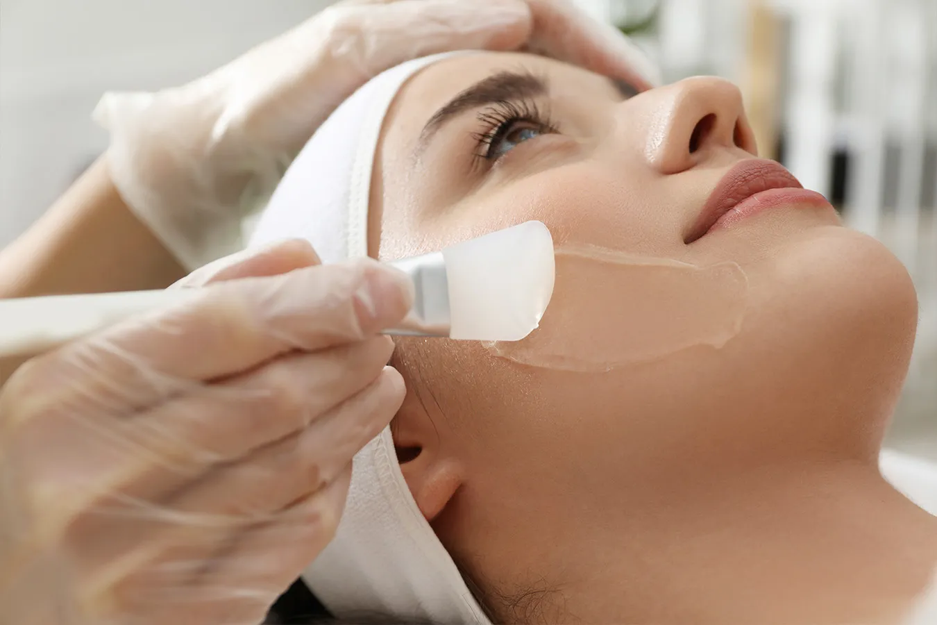 chemcial-peel