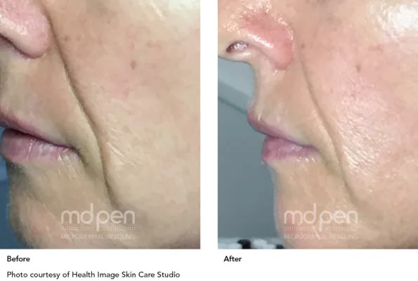 microneedling-1