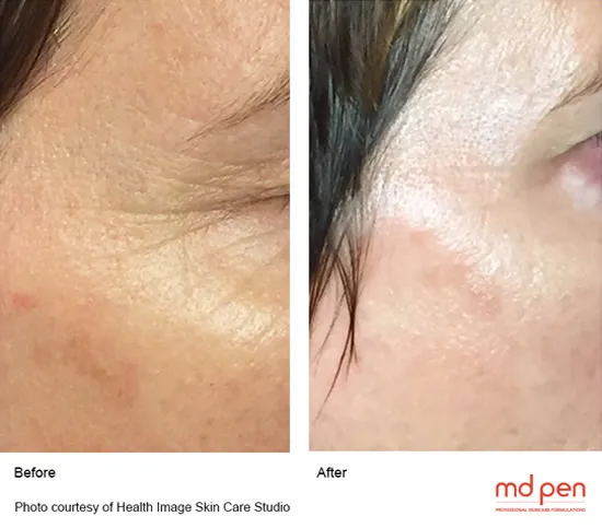 microneedling-2